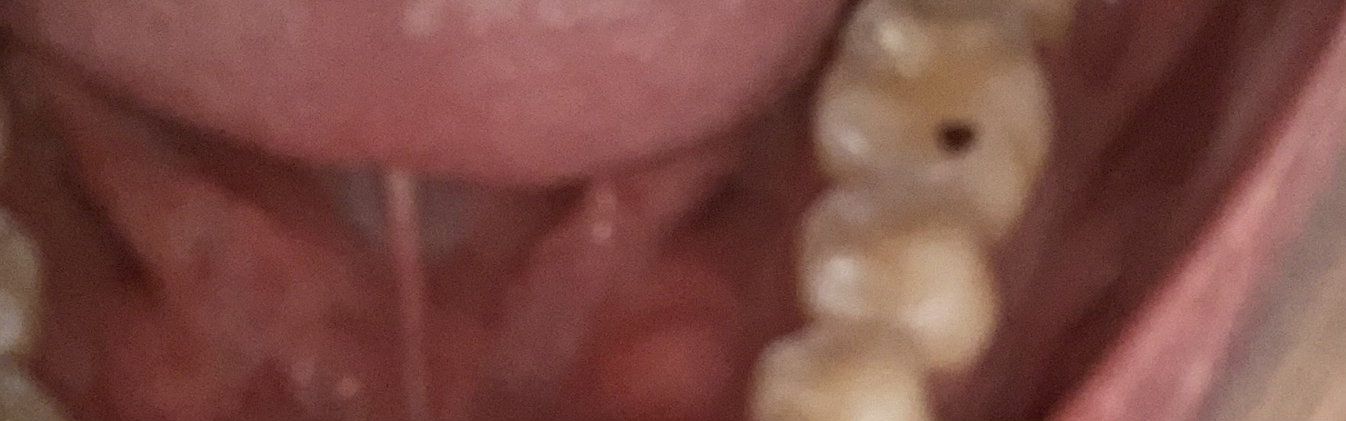 【画像】歯にホクロみたいなのできたんやが、これって虫歯？